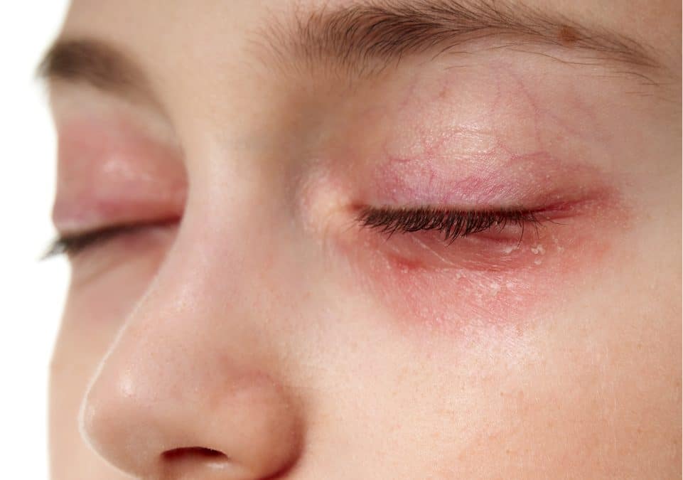 眼皮痕癢？眼皮發炎成因、症狀及治療方法 - 清晰眼科